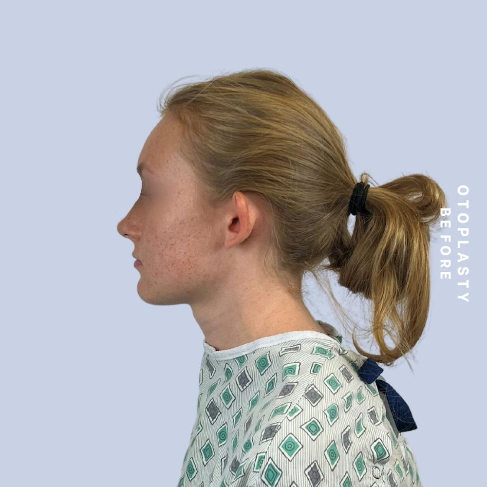 Ears Before & After Gallery - Patient 155009071 - Image 5