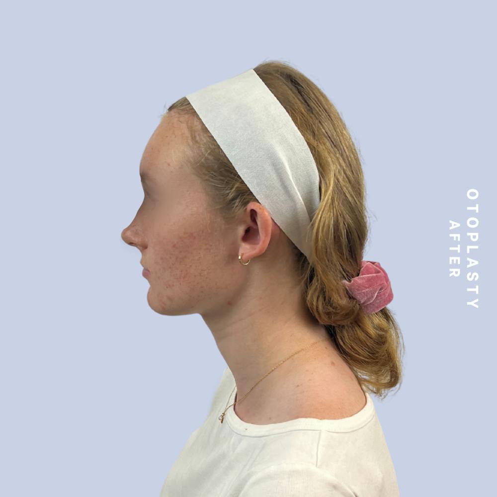 Ears Before & After Gallery - Patient 155009071 - Image 6
