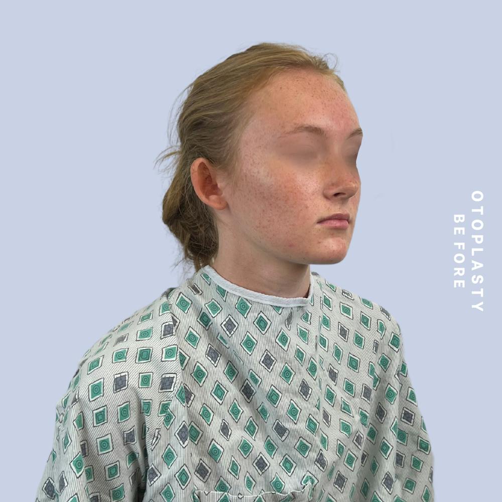 Ears Before & After Gallery - Patient 155009071 - Image 7
