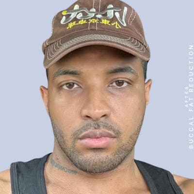 Buccal Fat Before & After Gallery - Patient 164621740 - Image 2