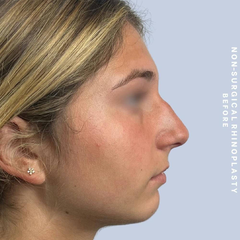 Nose Before & After Gallery - Patient 175299392 - Image 1