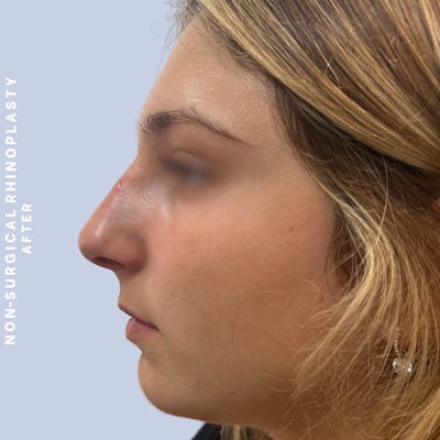 Non-Surgical Nose Before & After Gallery - Patient 175299392 - Image 4