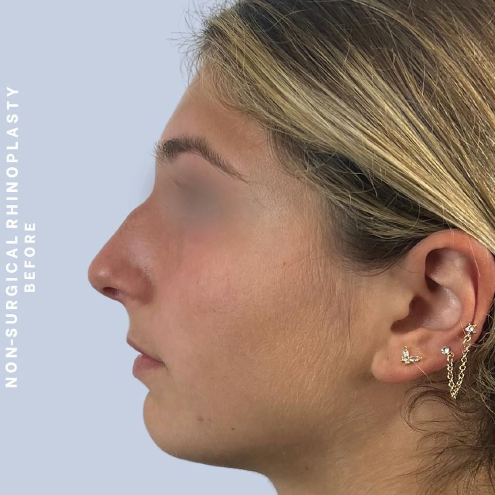 Non-Surgical Nose Before & After Gallery - Patient 175299392 - Image 3