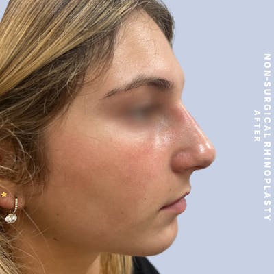 Nose Before & After Gallery - Patient 175299392 - Image 2