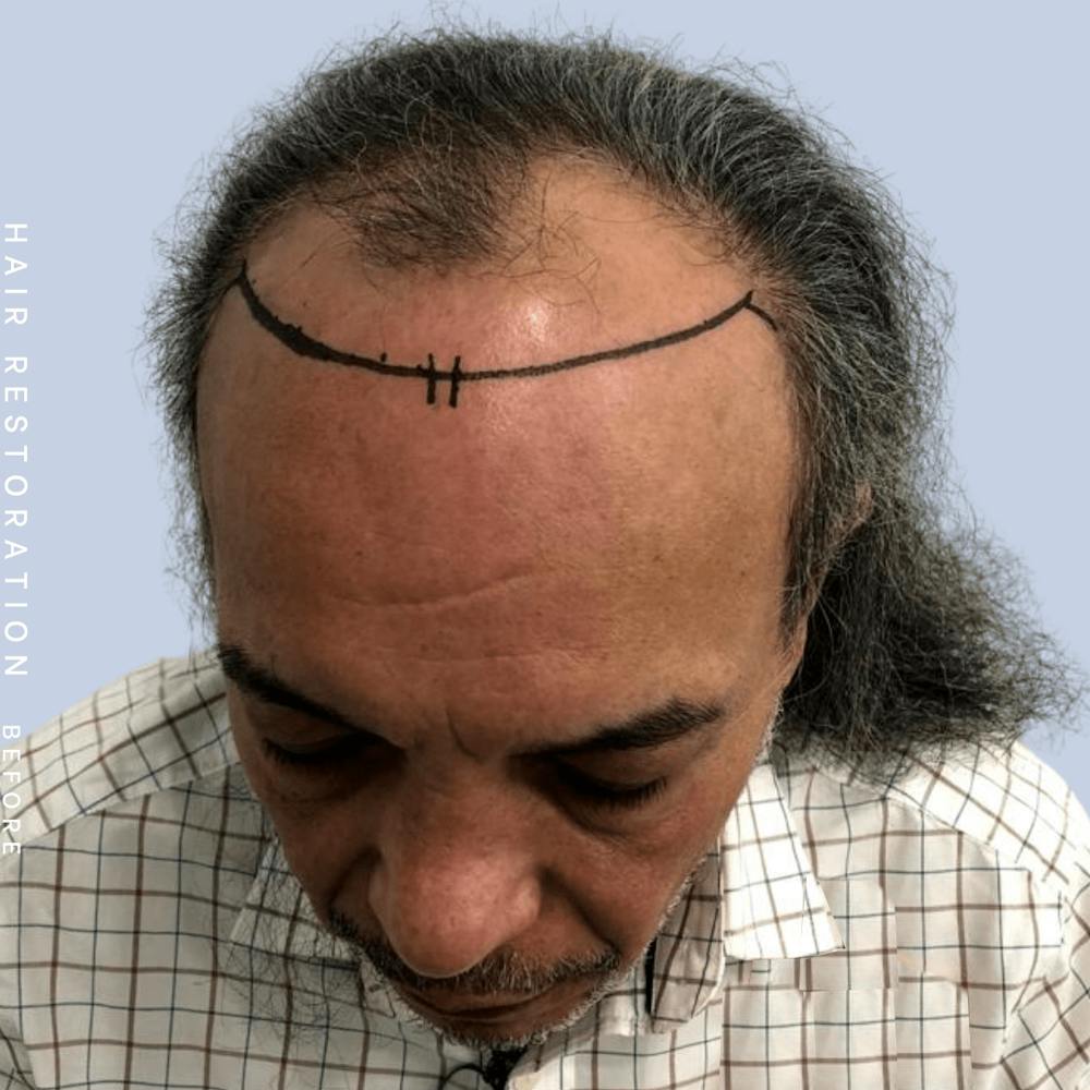 Hair Restoration Before & After Gallery - Patient 108743800 - Image 3