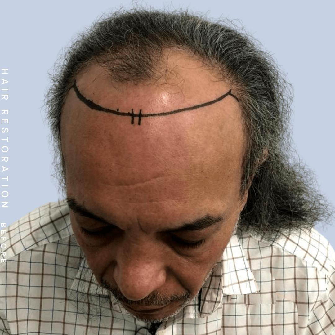 Hair Restoration Before & After Gallery - Patient 108743800 - Image 3