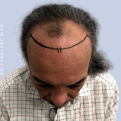 Men's Hair Before & After Gallery - Patient 108745184 - Image 1