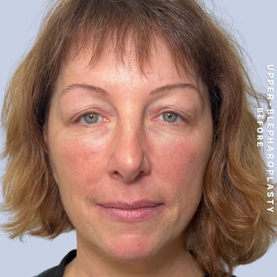 Eyes Before & After Gallery - Patient 170764 - Image 1