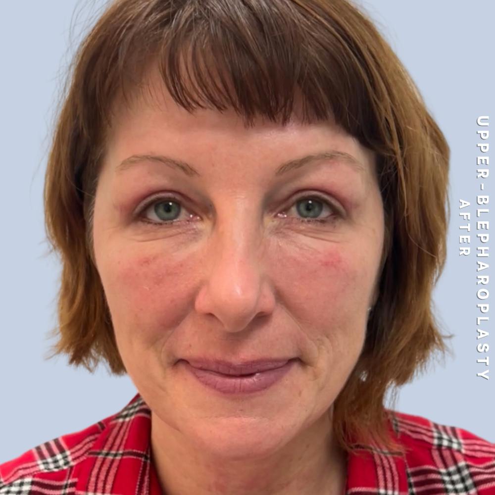 Eyes Before & After Gallery - Patient 170764 - Image 2