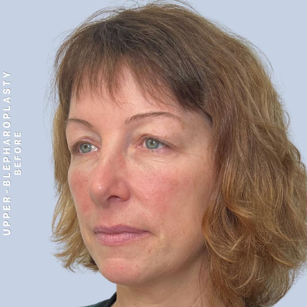 Eyes Before & After Gallery - Patient 170764 - Image 3