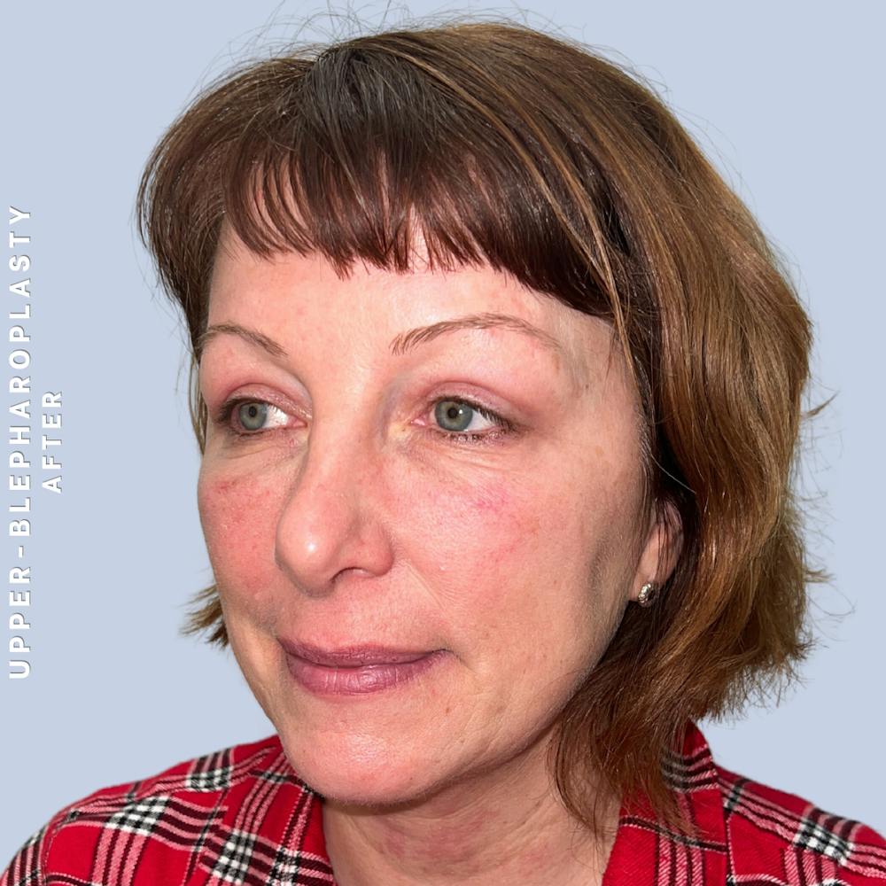 Eyes Before & After Gallery - Patient 170764 - Image 4
