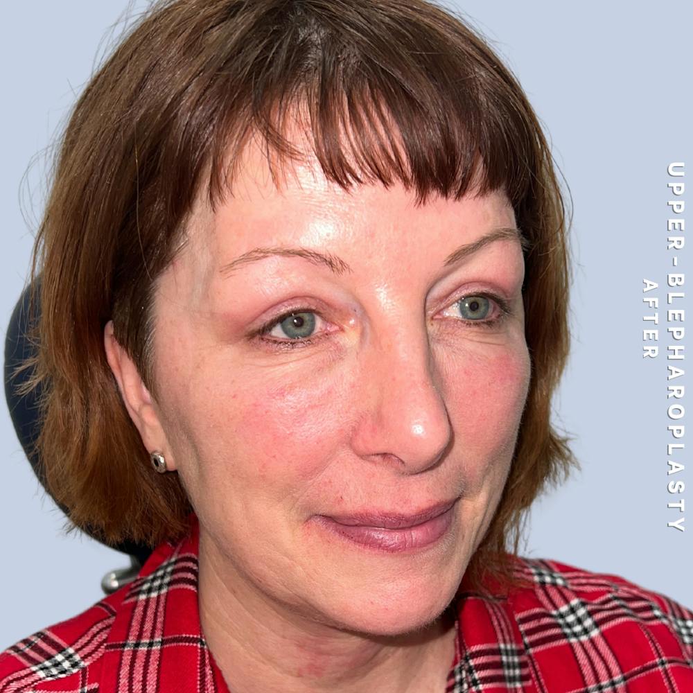 Eyes Before & After Gallery - Patient 170764 - Image 6
