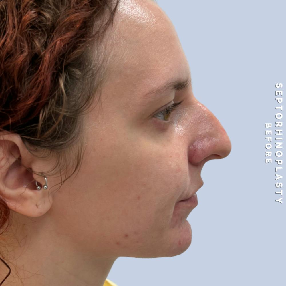 Nose Before & After Gallery - Patient 357016 - Image 5
