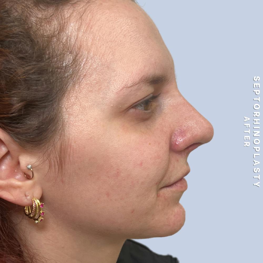 Nose Before & After Gallery - Patient 357016 - Image 6