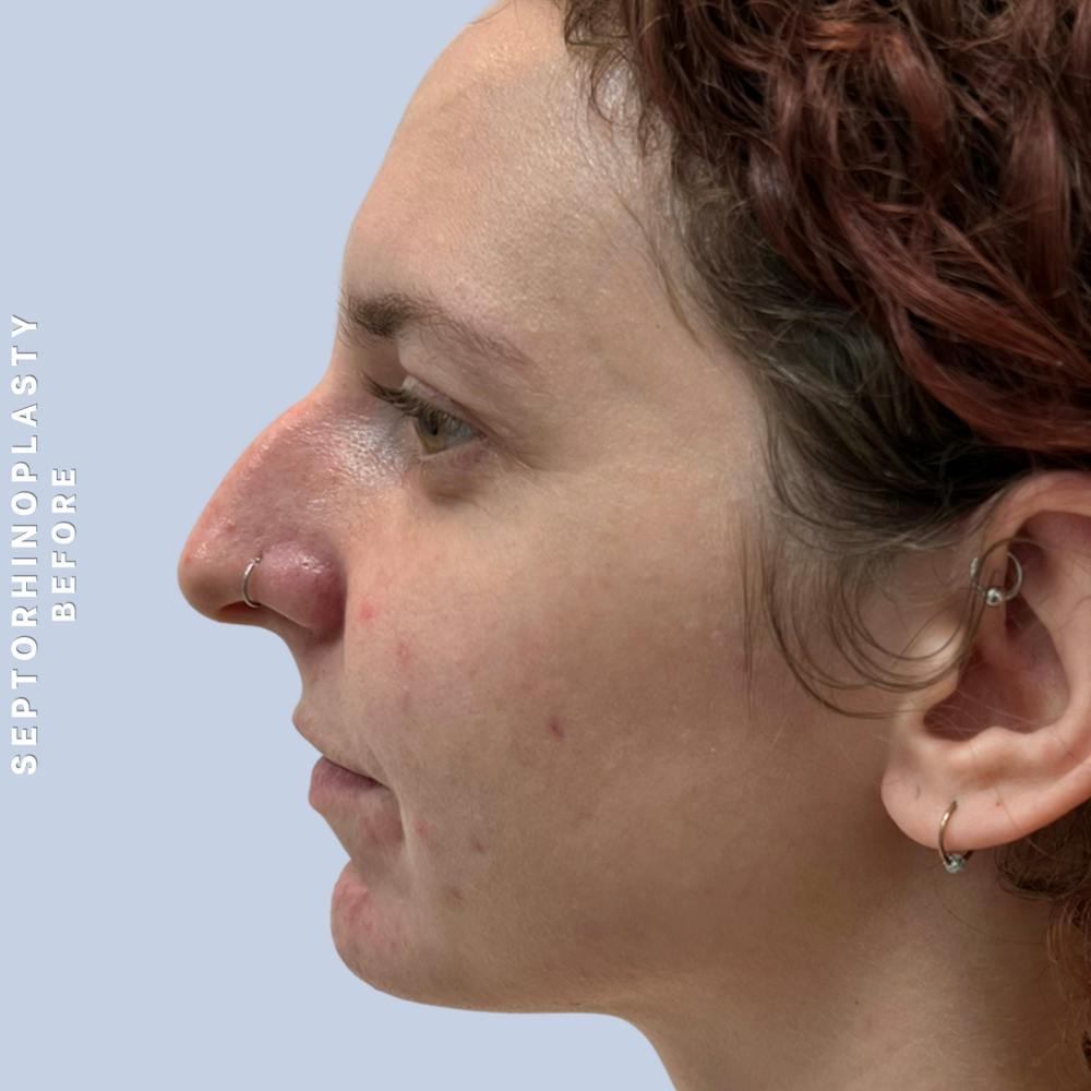 Nose Before & After Gallery - Patient 357016 - Image 7