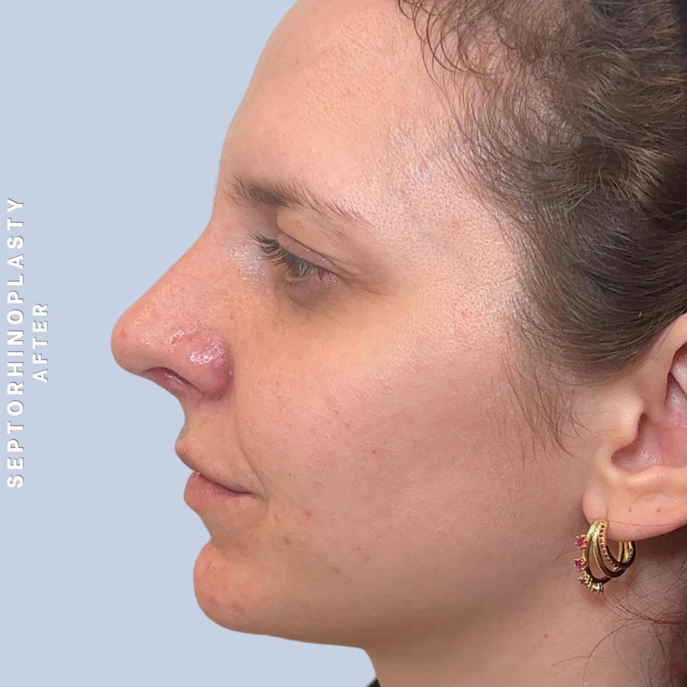 Nose Before & After Gallery - Patient 357016 - Image 8