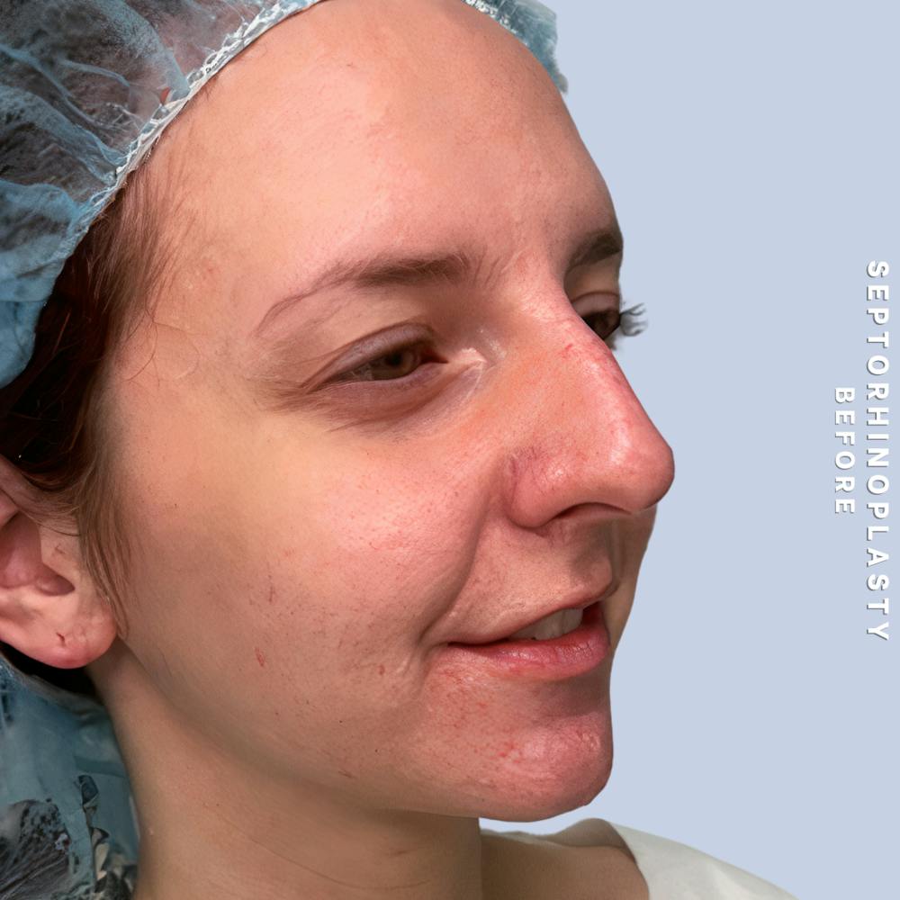 Nose Before & After Gallery - Patient 357016 - Image 3