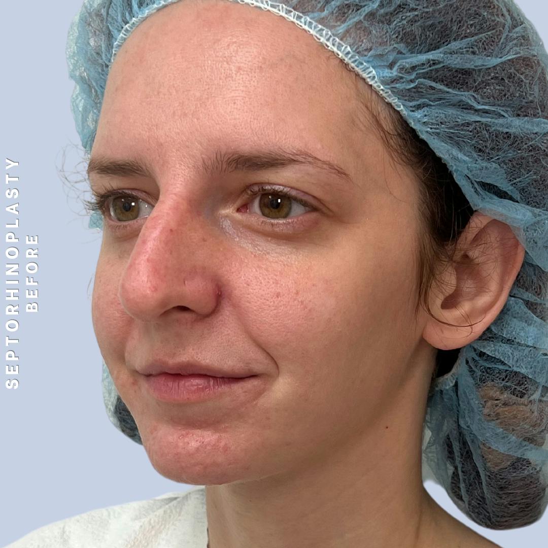 Nose Before & After Gallery - Patient 357016 - Image 9