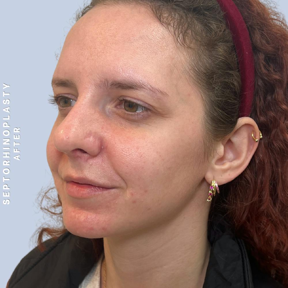 Nose Before & After Gallery - Patient 357016 - Image 10