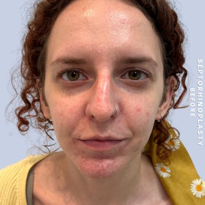 Nose Before & After Gallery - Patient 357016 - Image 1