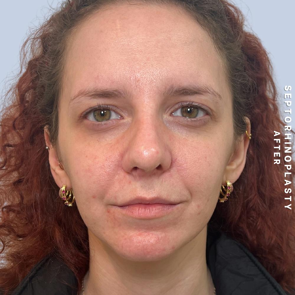 Nose Before & After Gallery - Patient 357016 - Image 2