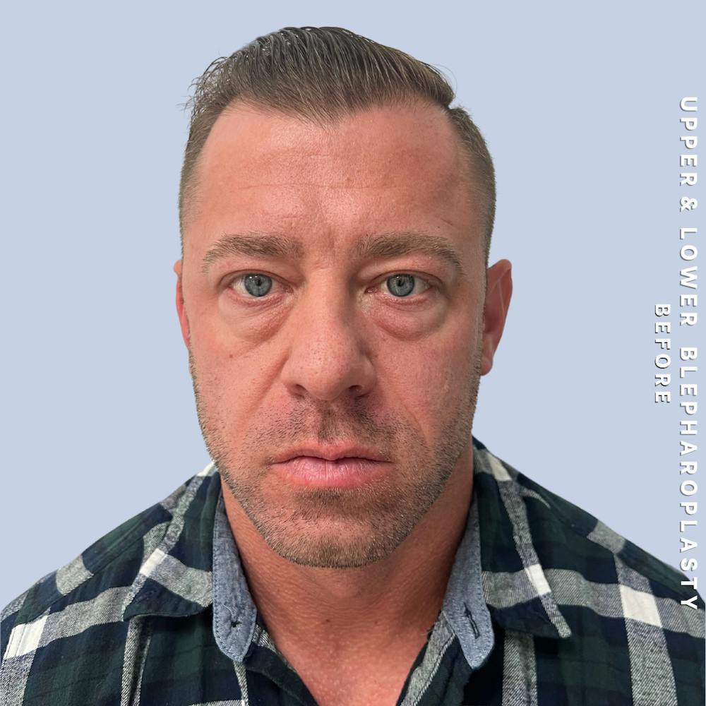 Men's Eyes Before & After Gallery - Patient 361414 - Image 1