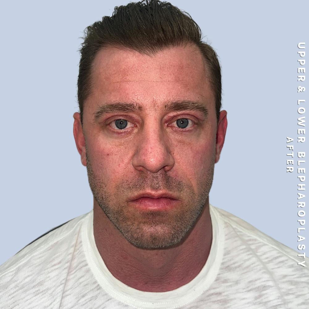 Men's Eyes Before & After Gallery - Patient 361414 - Image 2
