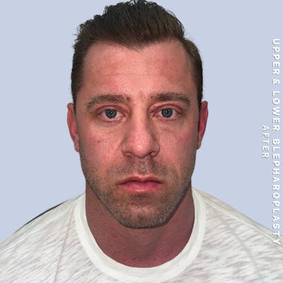 Men's Eyes Before & After Gallery - Patient 361414 - Image 2