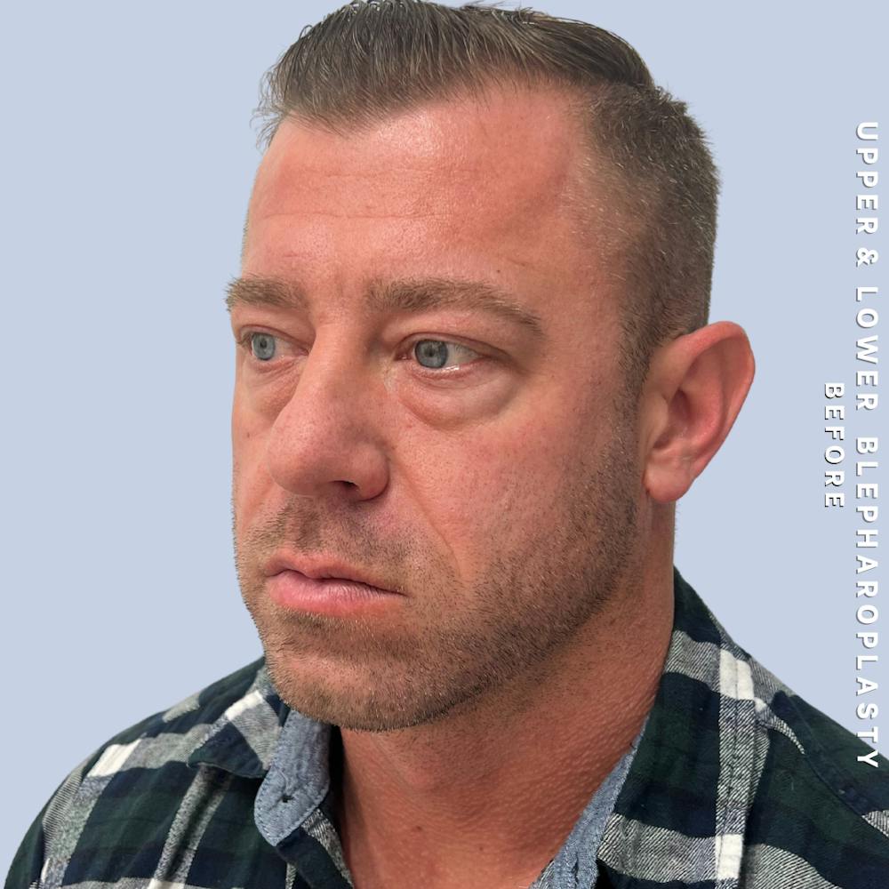 Men's Eyes Before & After Gallery - Patient 361414 - Image 3