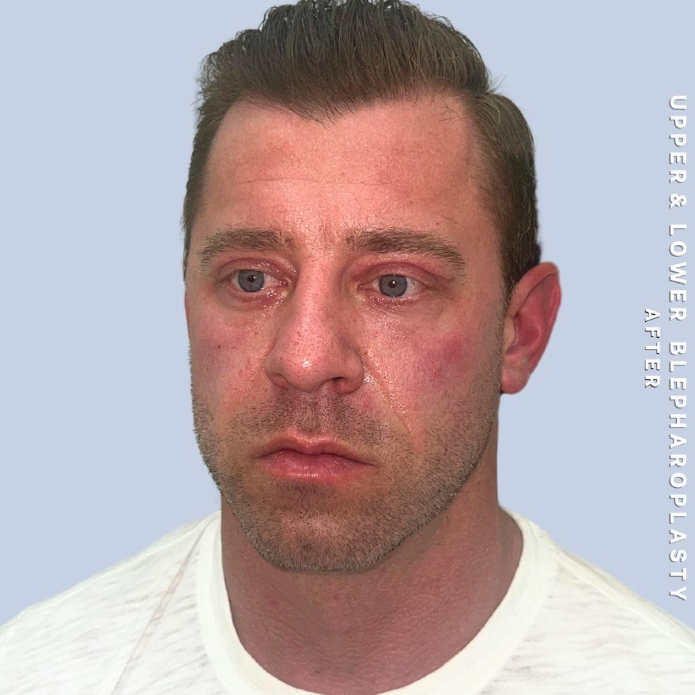 Men's Eyes Before & After Gallery - Patient 361414 - Image 4