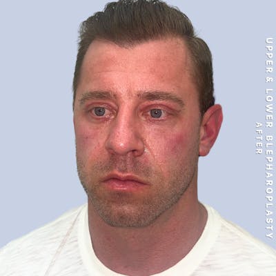 Men's Eyes Before & After Gallery - Patient 361414 - Image 4