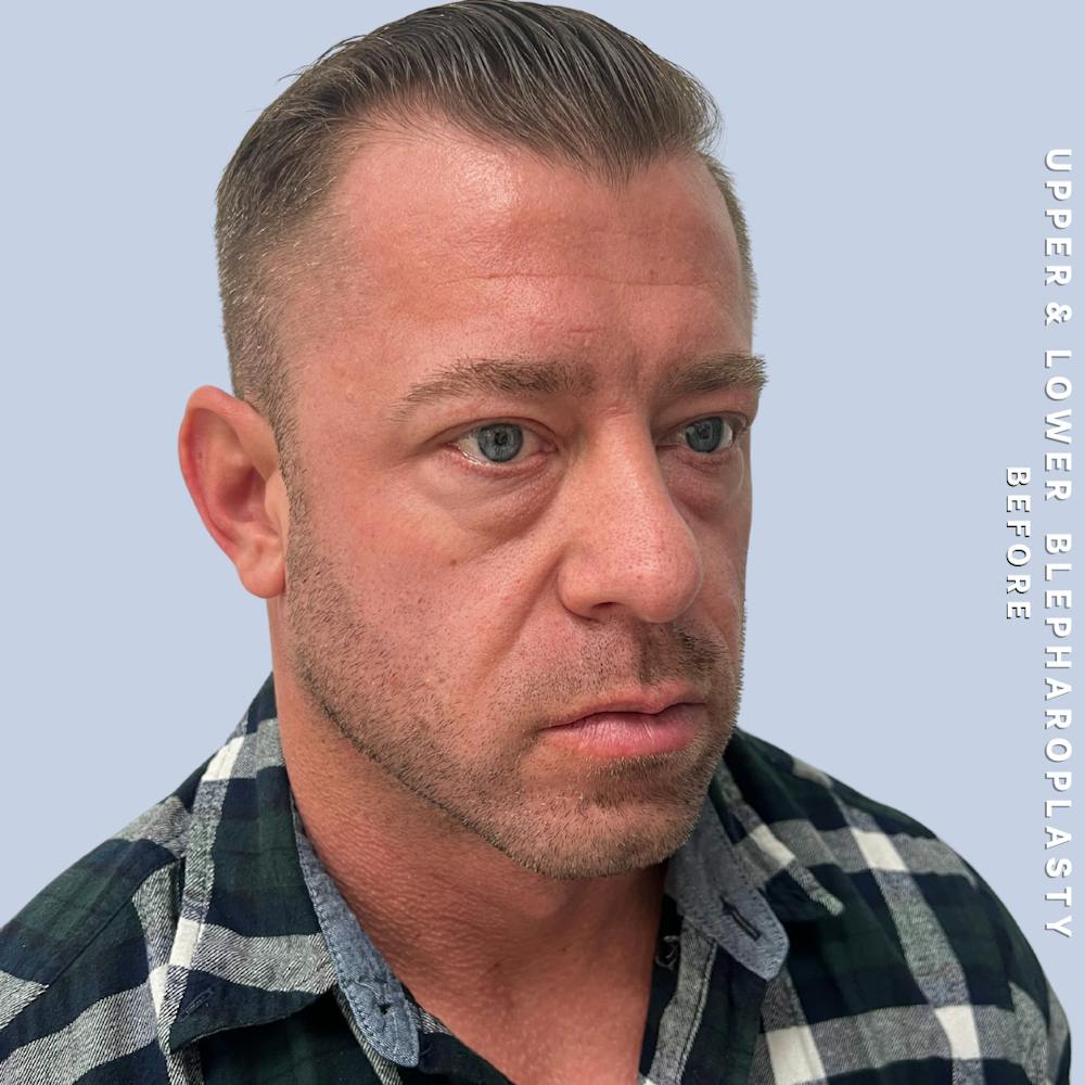 Men's Eyes Before & After Gallery - Patient 361414 - Image 5