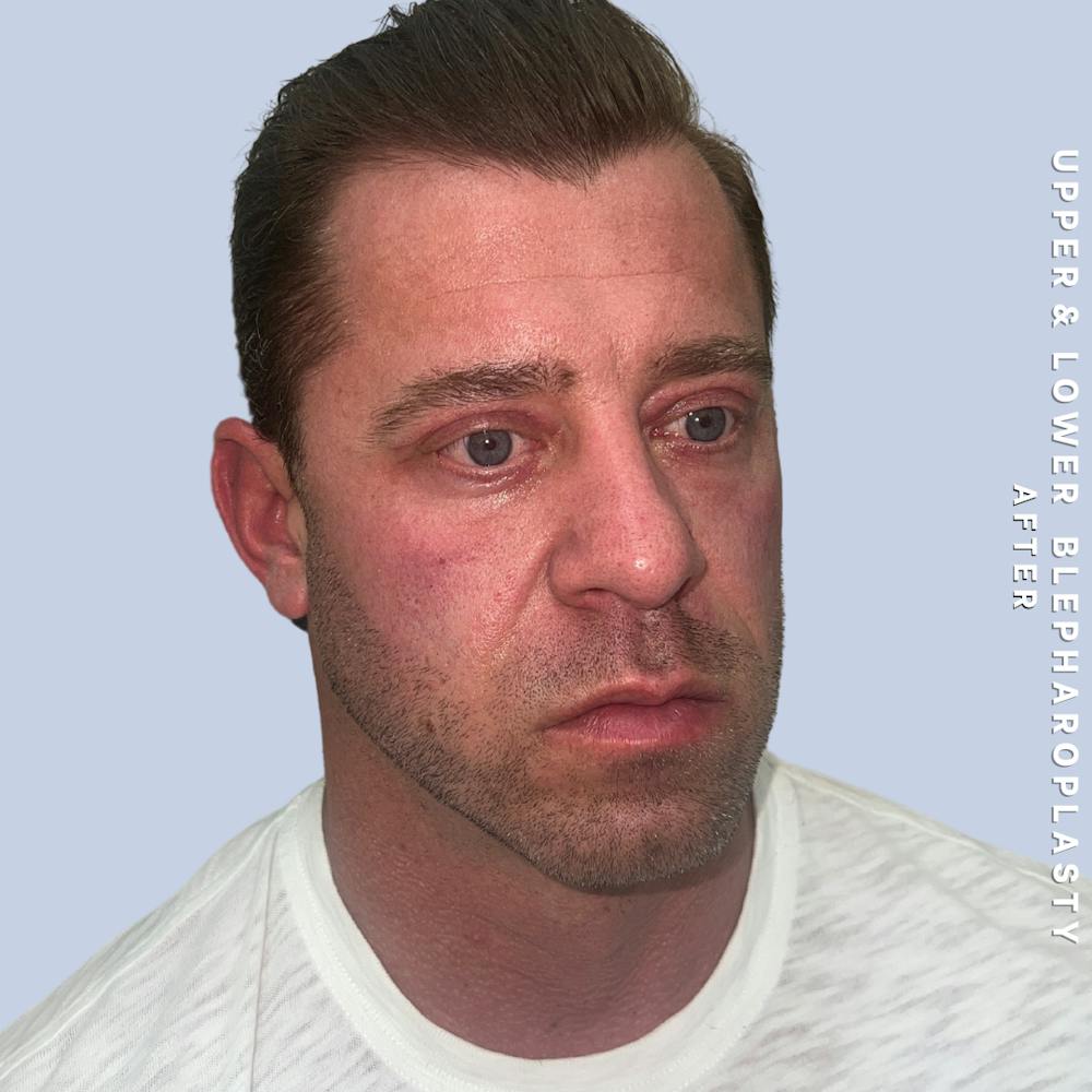 Men's Eyes Before & After Gallery - Patient 361414 - Image 6
