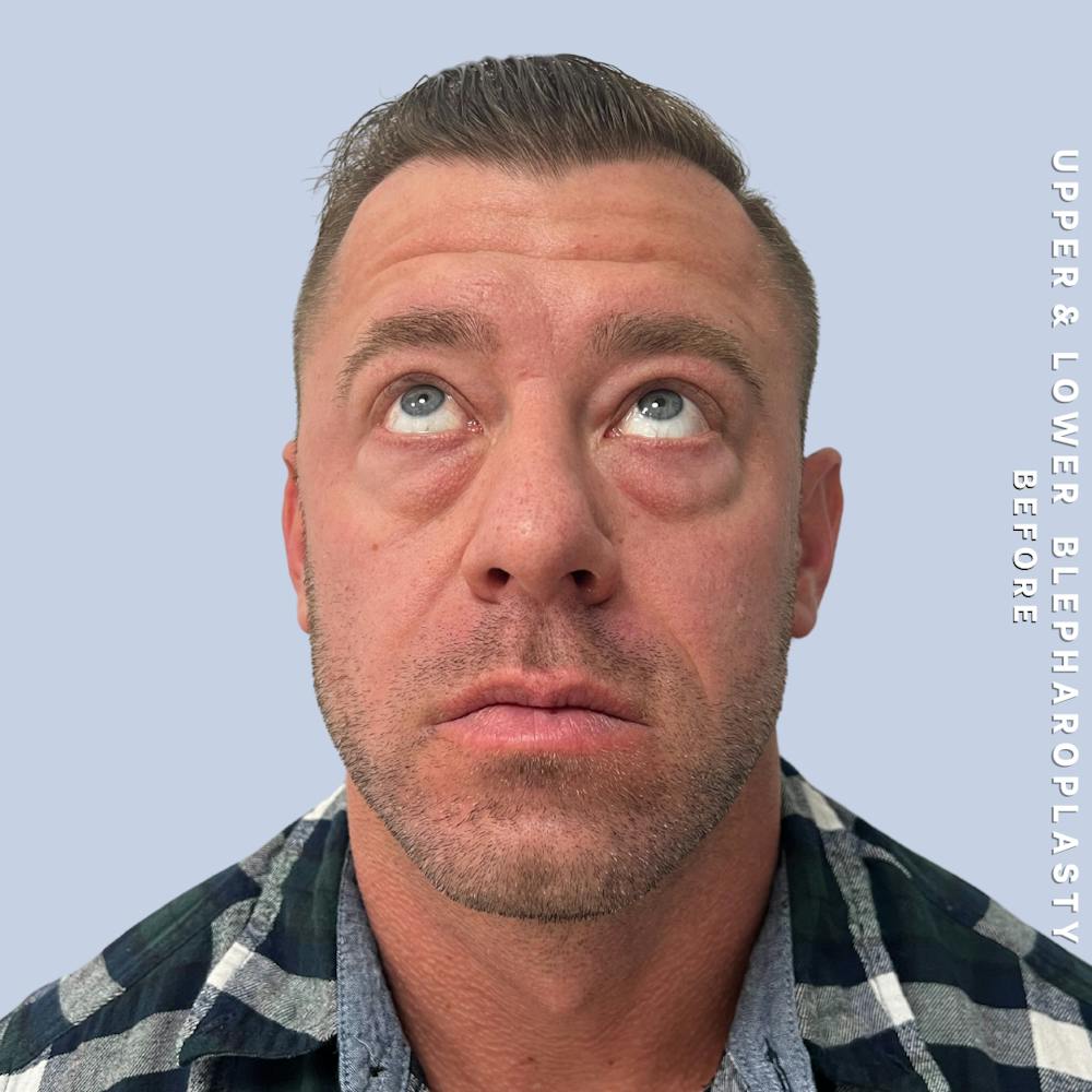 Men's Eyes Before & After Gallery - Patient 361414 - Image 7