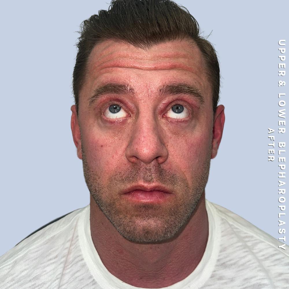 Men's Eyes Before & After Gallery - Patient 361414 - Image 8