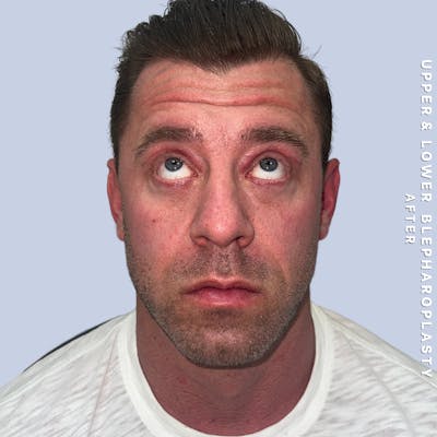 Men's Eyes Before & After Gallery - Patient 361414 - Image 8