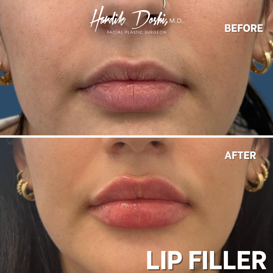 Dr. Hardik Doshi  Blog | Tips For After Receiving Lip Fillers