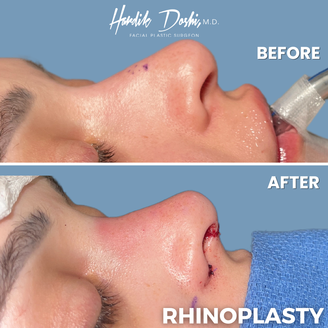 Dr. Hardik Doshi  Blog | Rhinoplasty Post-Operative Tips