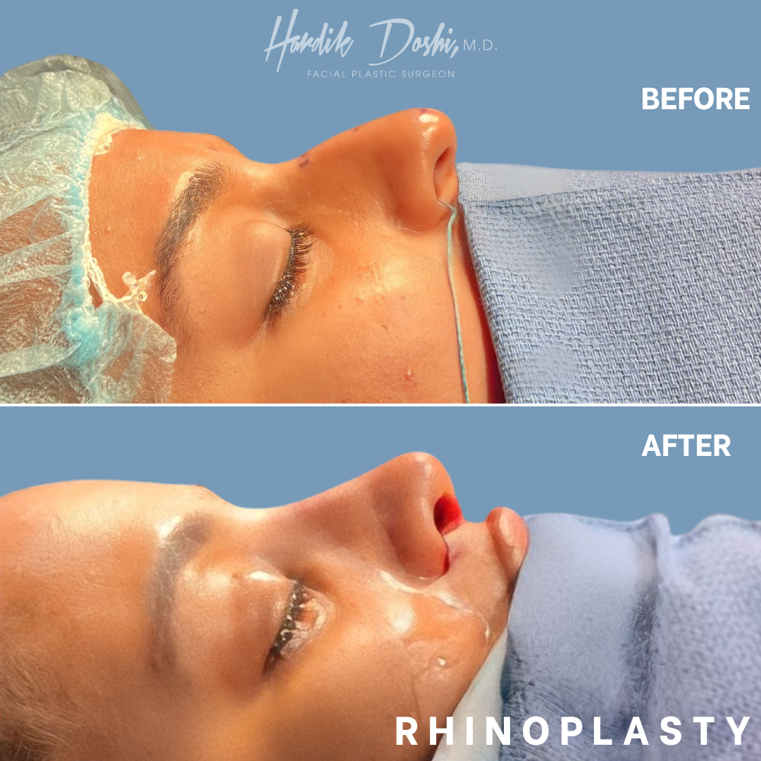 Dr. Hardik Doshi  Blog | Pre-Operative Instructions – Rhinoplasty