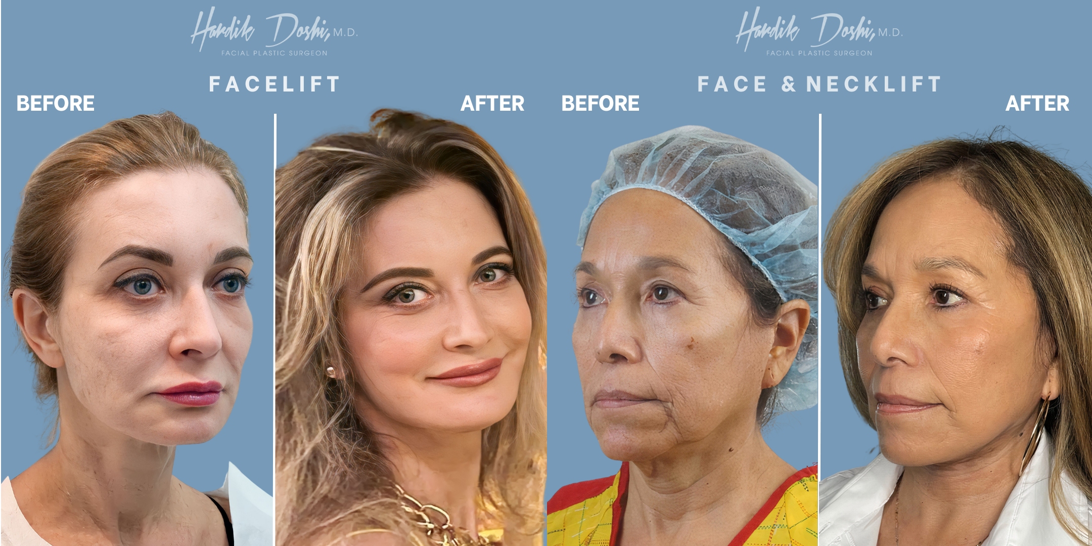 Dr. Hardik Doshi  Blog | Types of Facelifts