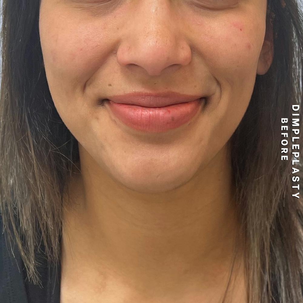 Dimpleplasty Before & After Gallery - Patient 339739 - Image 1