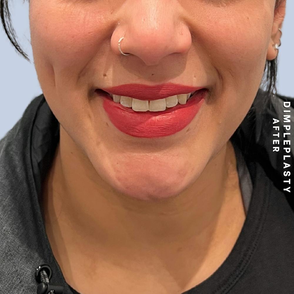 Dimpleplasty Before & After Gallery - Patient 339739 - Image 2