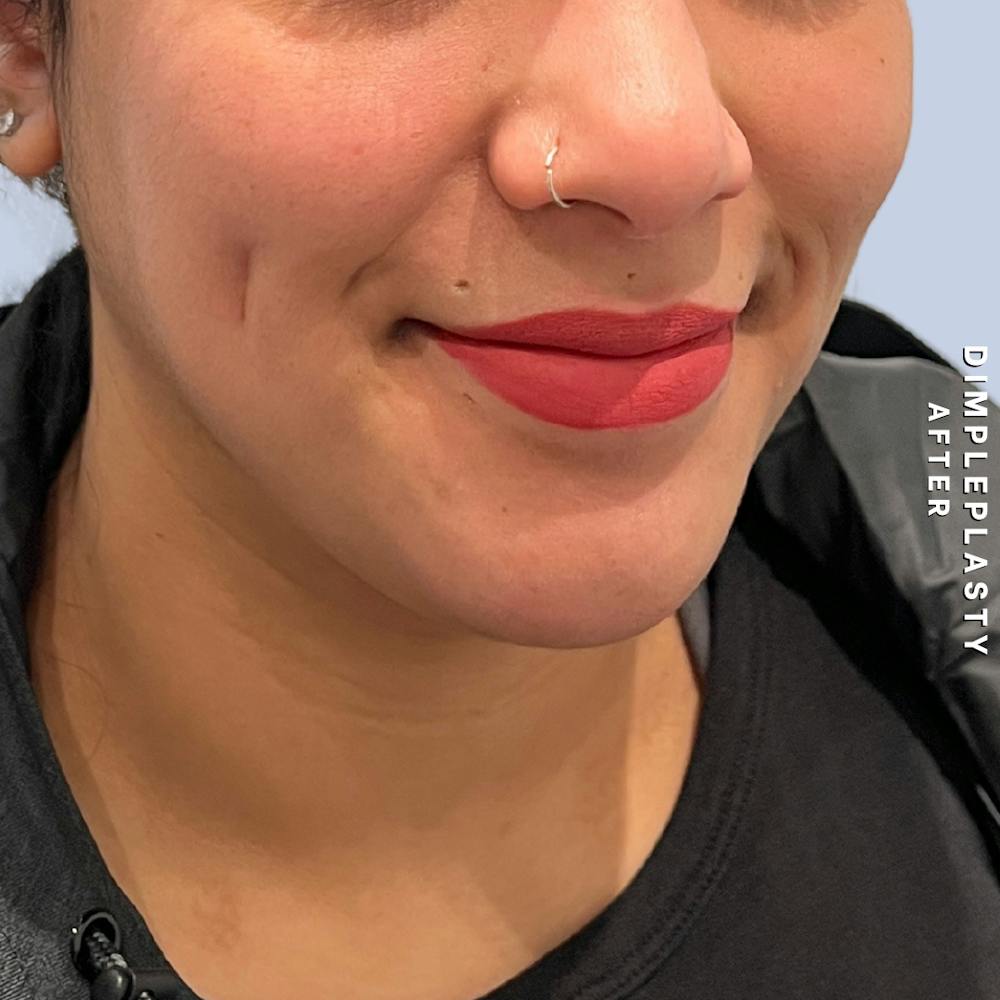 Dimpleplasty Before & After Gallery - Patient 339739 - Image 4