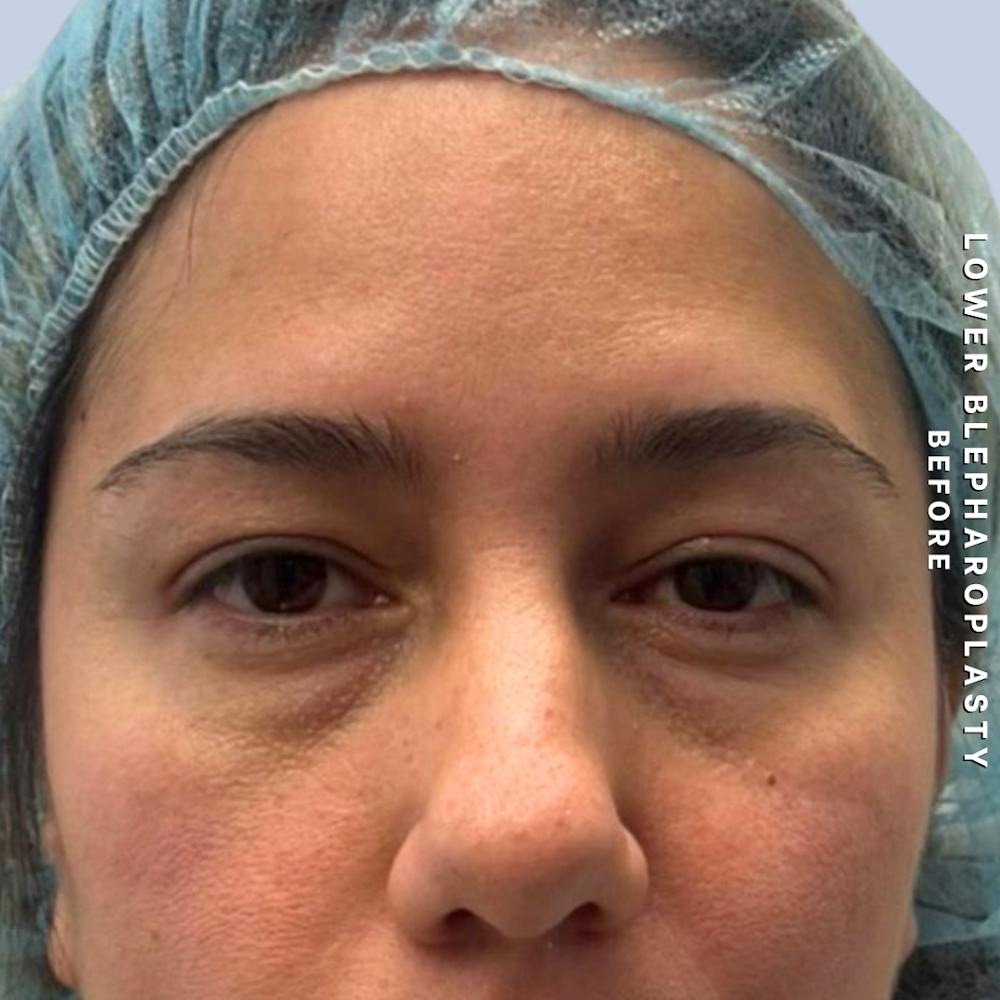 Eyes Before & After Gallery - Patient 334375 - Image 1