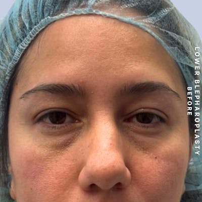 Eyes Before & After Gallery - Patient 334375 - Image 1