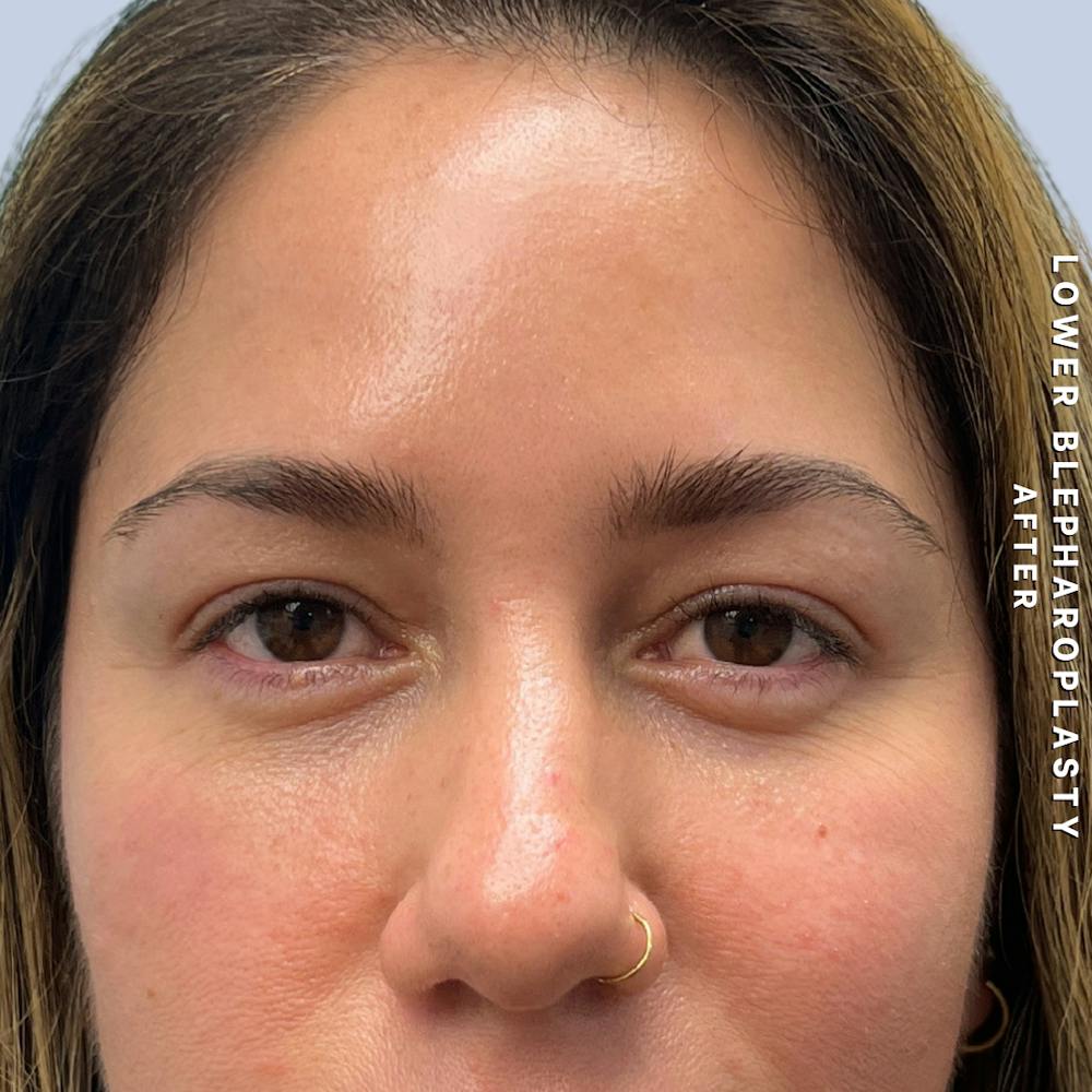 Eyes Before & After Gallery - Patient 334375 - Image 2