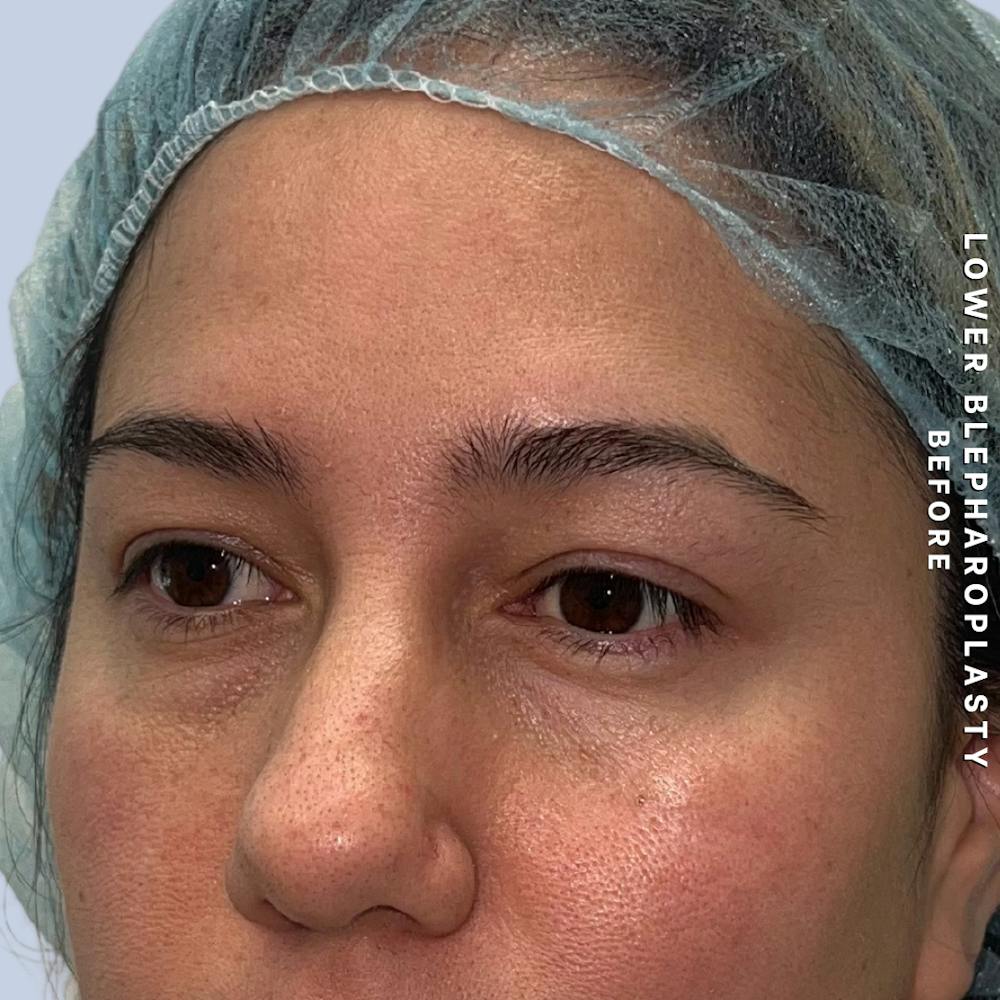 Eyes Before & After Gallery - Patient 334375 - Image 3