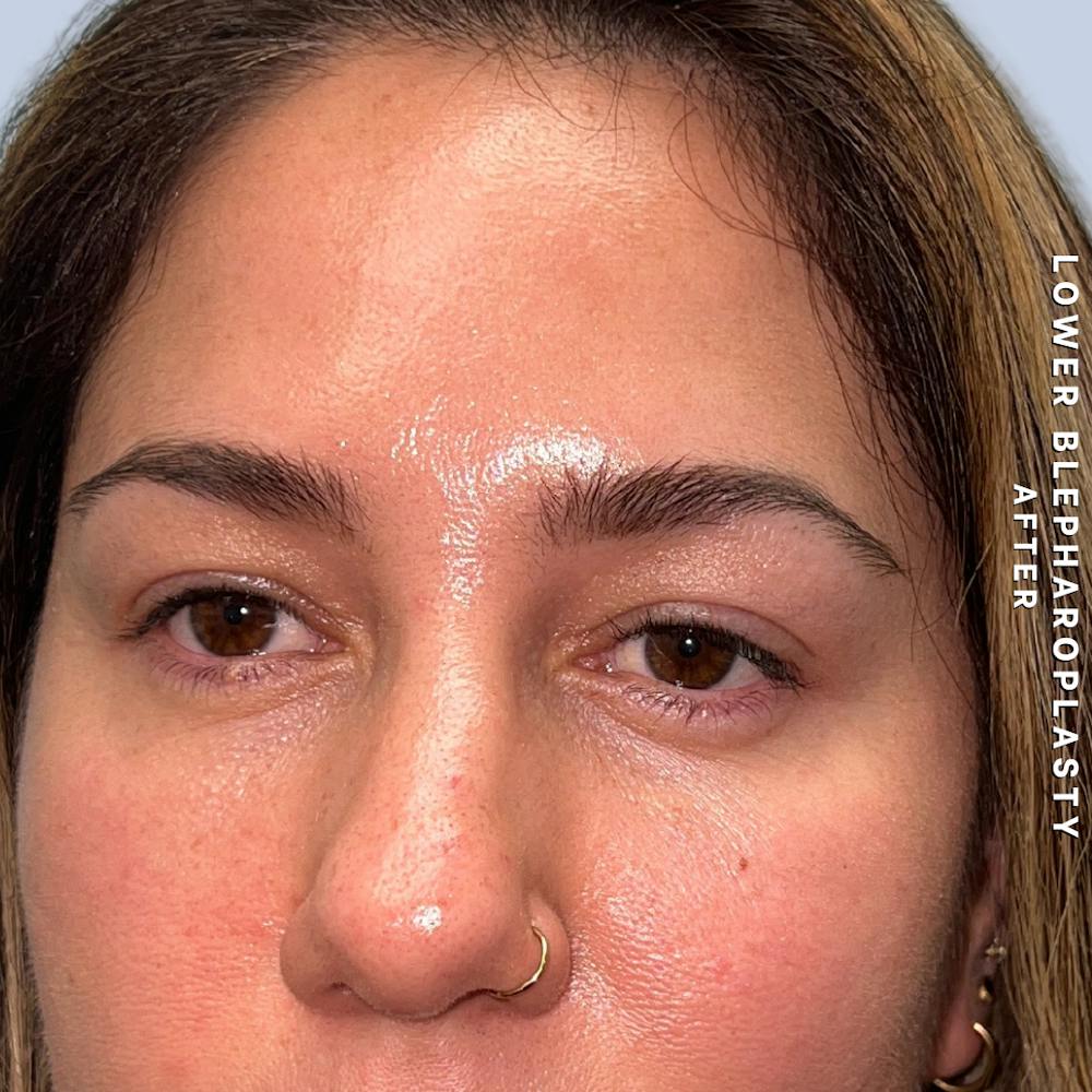 Eyes Before & After Gallery - Patient 334375 - Image 4