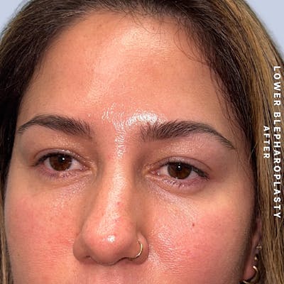 Eyes Before & After Gallery - Patient 334375 - Image 4