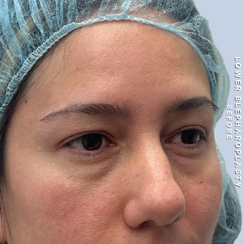 Eyes Before & After Gallery - Patient 334375 - Image 5